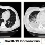 Coronavirusul CovID-19 care produce SARS 2 nu dă o pneumonie tipică