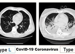 fenotipuri coronavirus Covid19 L H