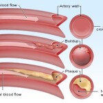 Angina fara obstructie coronariana